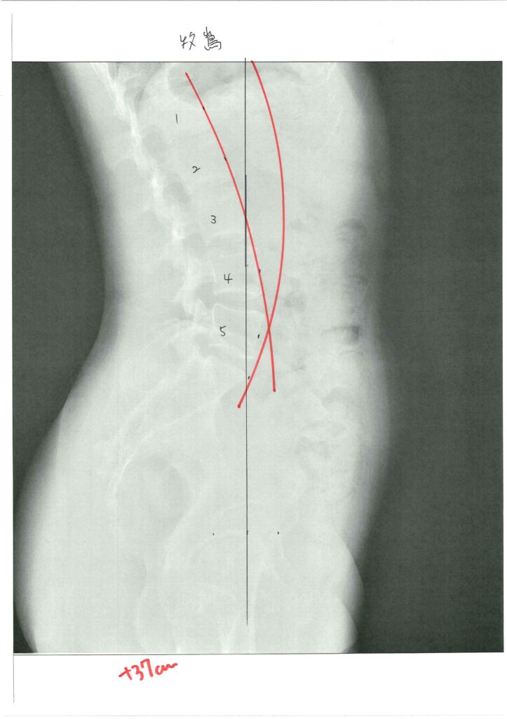 初回レントゲン画像（腰：側面）