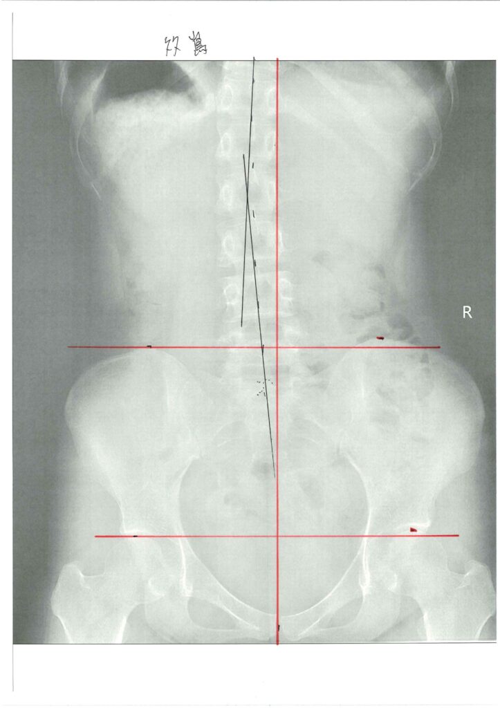 初回レントゲン画像（腰：正面）