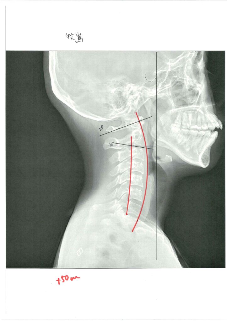 初回レントゲン画像（首：側面）